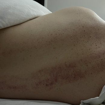 Asian Massage - Bruising from the massage parlor - Massage Near Me - Miami, Florida Asian Massage - Bruising from the massage parlor - Massage Near Me - Miami, Florida