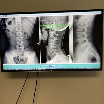 Upper Cervical Chiropractic San Diego - My X-rays - Chiropractors Near Me - San Diego, California