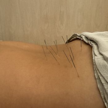WTHN  - lower back acupuncture - Acupuncture Near Me - New York, New York