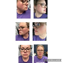 Brenda Donato, DMD - Fort Smith Smiles - My lips, PDO threads, and fillers on my 11 lines and around my mouth and even my chin