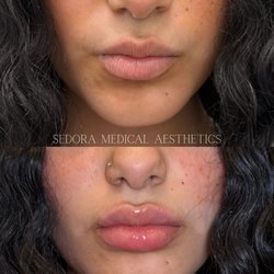Sedora Medical Spa - Before and after lips