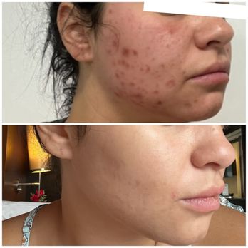Aloha Aesthetics MD - Acne scar laser facial - Medical Spas Near Me - Honolulu, Hawaii Aloha Aesthetics MD - Acne scar laser facial - Medical Spas Near Me - Honolulu, Hawaii
