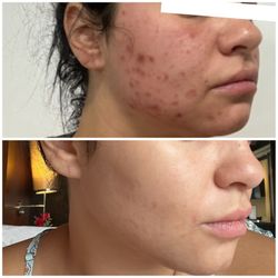 Aloha Aesthetics MD - Acne scar laser facial