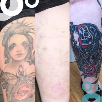 Removery - Before & After Shin Tattoo Removal - Tattoo Removal Near Me - Milwaukee, Wisconsin Removery - Before & After Shin Tattoo Removal - Tattoo Removal Near Me - Milwaukee, Wisconsin