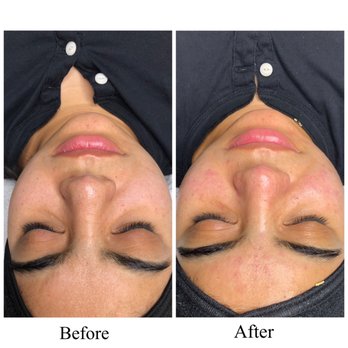 Impressive Beauty By Nhung - She extracted the heck out of my black heads! Lol love it - Permanent Makeup Near Me Impressive Beauty By Nhung - She extracted the heck out of my black heads! Lol love it - Permanent Makeup Near Me
