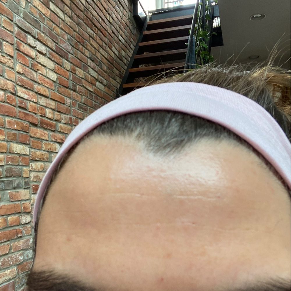 Manhattan Medspa - This was 3 days after Botox Injections - Medical Spas Near Me - New York, New York Manhattan Medspa - This was 3 days after Botox Injections - Medical Spas Near Me - New York, New York