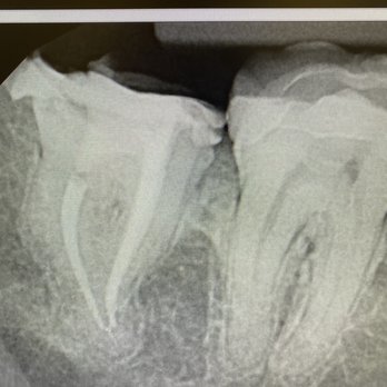 Foothill Dental Group - After my amazing root canal doctor Sohail did - General Dentistry Near Me - Hayward, California