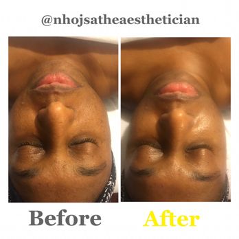 Nhojsa The Aesthetician - Facial before and after - Aestheticians Near Me - Chester, Virginia Nhojsa The Aesthetician - Facial before and after - Aestheticians Near Me - Chester, Virginia