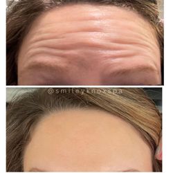 Smiley Aesthetics - Botox can literally reverse almost ANY wrinkles and/or fine lines and prevent them from happening again or even getting started!