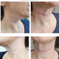 Marjan Spa - Neck Line Filler
