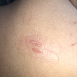 Here is the burn after taking bandage off Here is the burn after taking bandage off