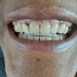Bolon Rebecca P.DDS - Can you point out the partial tooth?