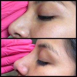 A1 Beauty MedSpa - Non surgical Nose Job