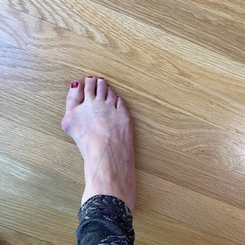 Ashkan Soleymani, DPM - This is what my foot looked like before the surgery, only this is my right foot. He operated on my left foot. Totally before and after ! - Podiatrists Near Me - Inglewood, California Ashkan Soleymani, DPM - This is what my foot looked like before the surgery, only this is my right foot. He operated on my left foot. Totally before and after ! - Podiatrists Near Me - Inglewood, California