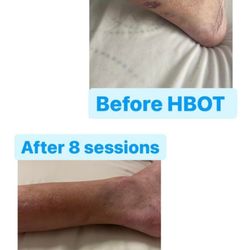 RX-O2 Hyperbaric Clinics - A recent patient shared he wonderful results with our clinic after treatment! We love to share these success stories. HBOT Heals!