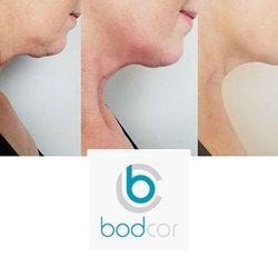 Bodcor West Valley - Bodcor can be used on all trouble areas included the chin.