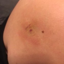 Kyle F Chun, MD - 1 week post op.