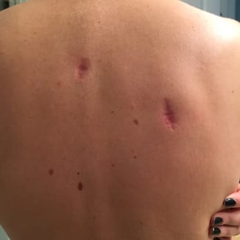 Spicewood Dermatology - My mole removal and how badly it was done - Dermatologists Near Me - Austin, Texas Spicewood Dermatology - My mole removal and how badly it was done - Dermatologists Near Me - Austin, Texas