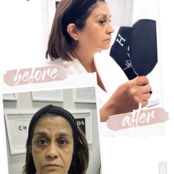 Shape Your Body By Mary - New Face. Whose this? Non surgical face lift. - Body Contouring Near Me - Scottsdale, Arizona Shape Your Body By Mary - New Face. Whose this? Non surgical face lift. - Body Contouring Near Me - Scottsdale, Arizona