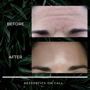 Aesthetics On Call - One of our favorite clients!  Glabellar (between brows/11 lines) and forehead treatments. - Medical Spas Near Me - Honolulu, Hawaii