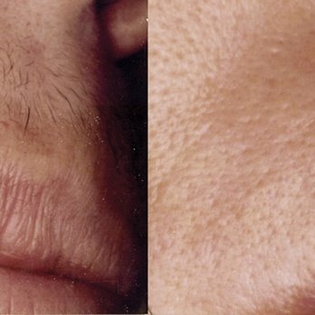 Body Hair Gone - Upper lip/before & after - Hair Removal Near Me - Dallas, Texas Body Hair Gone - Upper lip/before & after - Hair Removal Near Me - Dallas, Texas
