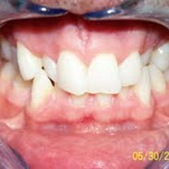 Cleveland Circle Dental Associates - This is a very difficult case because of the bite and crowding. - General Dentistry Near Me - Brookline, Massachusetts Cleveland Circle Dental Associates - This is a very difficult case because of the bite and crowding. - General Dentistry Near Me - Brookline, Massachusetts