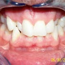 Cleveland Circle Dental Associates - This is a very difficult case because of the bite and crowding.