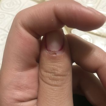 Lee Nails - Infected cut from the drill. I ended up having to take the nails off after three days because all of them were chipping and breaking. - Nail Salons Near Me - Chicago, Illinois Lee Nails - Infected cut from the drill. I ended up having to take the nails off after three days because all of them were chipping and breaking. - Nail Salons Near Me - Chicago, Illinois