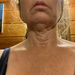 Charlottesville Oral Surgery & Dental Implant Center - Premature wrinkling of neck due to stretching from excessive infection fluid.