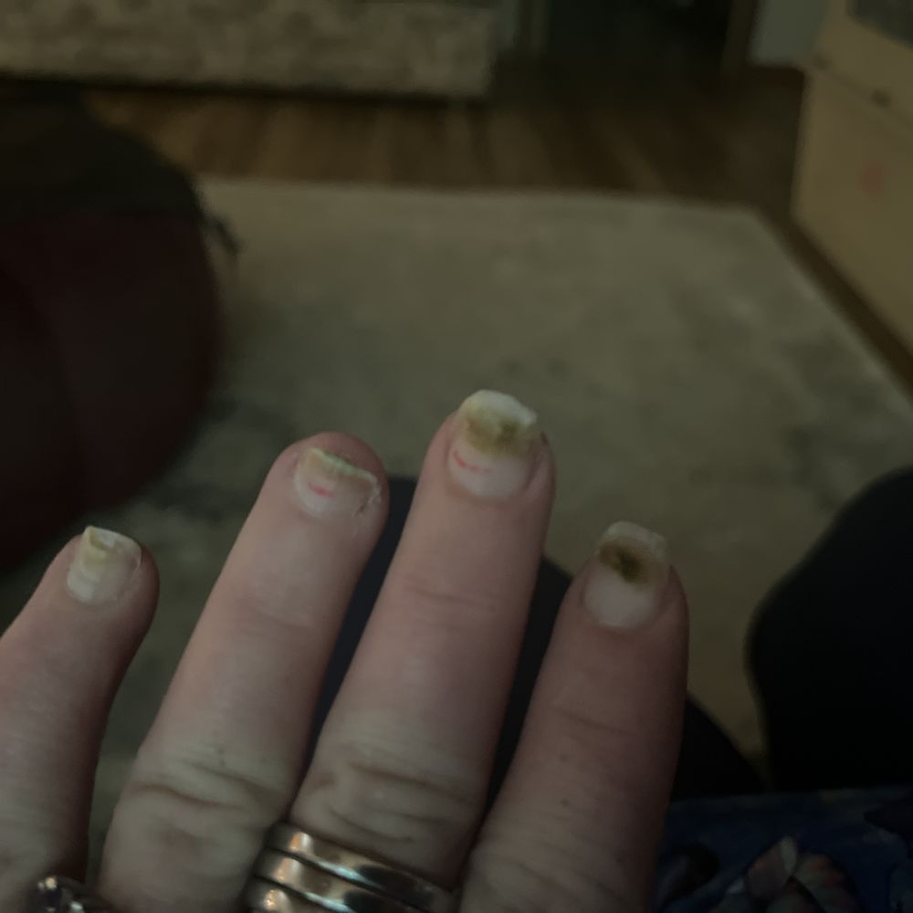 California Nails - Disgusting nails with fungus - Nail Salons Near Me - Olympia , Washington California Nails - Disgusting nails with fungus - Nail Salons Near Me - Olympia , Washington