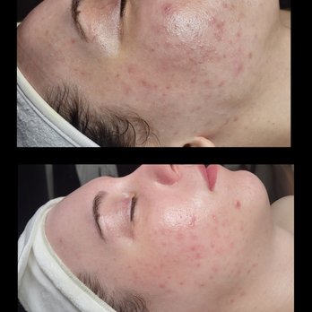 Serenity Spa By Shana - Treating inflammation can be tricky! We've been working hard on her skin!! This is a 1 month difference between the top and bottom photos! - Estheticians Near Me - Onalaska, Wisconsin Serenity Spa By Shana - Treating inflammation can be tricky! We've been working hard on her skin!! This is a 1 month difference between the top and bottom photos! - Estheticians Near Me - Onalaska, Wisconsin