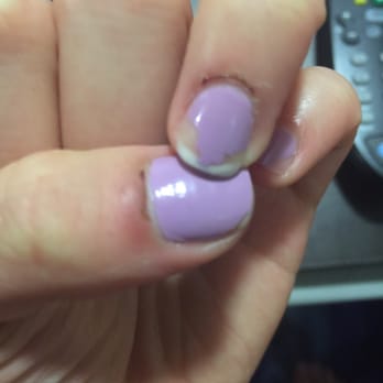 Allure Nails - 3 days after the manicure, this is how my cuticles look--scabs from the bleeding because she cut way too much! - Nail Salons Near Me - Mishawaka, Indiana Allure Nails - 3 days after the manicure, this is how my cuticles look--scabs from the bleeding because she cut way too much! - Nail Salons Near Me - Mishawaka, Indiana