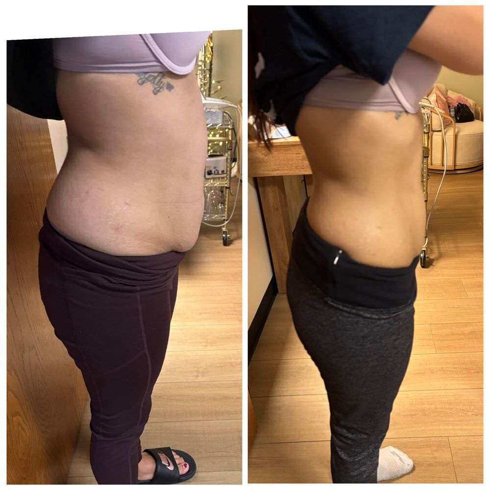 sore throat tirzepatide 18 Possible Side Effects of (Mounjaro, Zepbound) Quantity:6-Month Bundle firming neck cream Weight Loss with Semaglutide