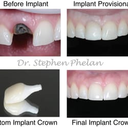 Phelan Dental - Single Tooth Dental Implant. This is an example of a excellent aesthetic and functional result of a single tooth implant rest...