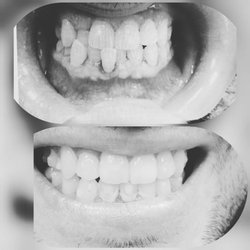 Williamsburg Dental Works - What happened?How?Invisalign happened...