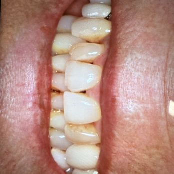 Oak Tree Dental - Before - General Dentistry Near Me - Poway, California Oak Tree Dental - Before - General Dentistry Near Me - Poway, California