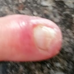 The cuts got infected, nail tip fell off, very painful. Thanks Dreamy nails! The cuts got infected, nail tip fell off, very painful. Thanks Dreamy nails!