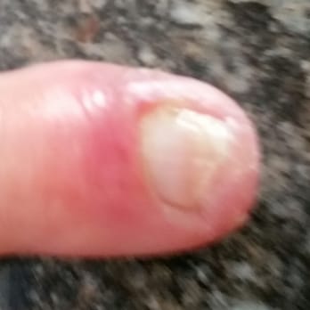 Dreamy Nails & Spa - The cuts got infected, nail tip fell off, very painful. Thanks Dreamy nails! - Nail Salons Near Me - Ramona, California Dreamy Nails & Spa - The cuts got infected, nail tip fell off, very painful. Thanks Dreamy nails! - Nail Salons Near Me - Ramona, California