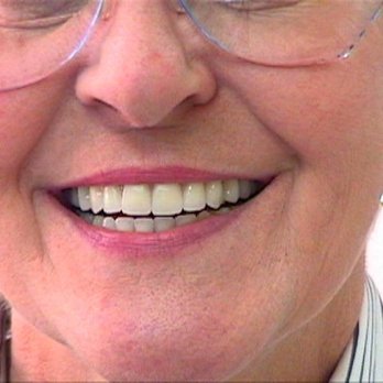 Scott Brooksby, DDS - Sequim Advanced Dental - AFTER NEW DENTURES - General Dentistry Near Me - Sequim, Washington Scott Brooksby, DDS - Sequim Advanced Dental - AFTER NEW DENTURES - General Dentistry Near Me - Sequim, Washington