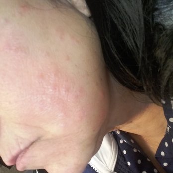 Four Seasons Nails - both sides of face 5 days after still sucks - Nail Salons Near Me - Redlands, California Four Seasons Nails - both sides of face 5 days after still sucks - Nail Salons Near Me - Redlands, California