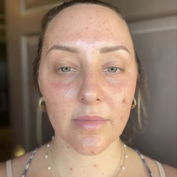 Phoenix Laser & Rejuvenation Center - Deep wrinkles on my forehead virtually invisible post treatment - Laser Hair Removal Near Me - Phoenix, Arizona Phoenix Laser & Rejuvenation Center - Deep wrinkles on my forehead virtually invisible post treatment - Laser Hair Removal Near Me - Phoenix, Arizona
