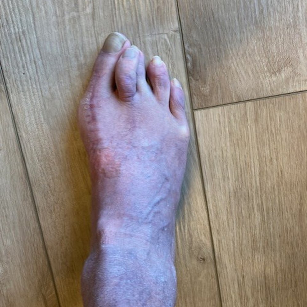 18 months post-surgery foot from Podiatry Associates 18 months post-surgery foot from Podiatry Associates