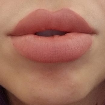 DermFx - Bumps in lips - Laser Hair Removal Near Me - Sunset Beach, California DermFx - Bumps in lips - Laser Hair Removal Near Me - Sunset Beach, California