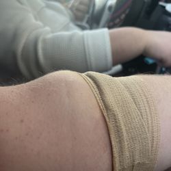 ADMA BioCenters - Myrtle Beach - Bubble on arm from failed return