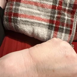This photo shows the swelling the day after the burn