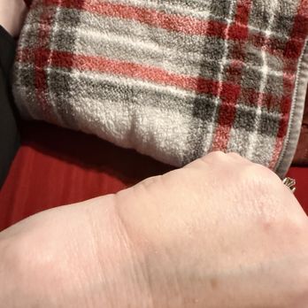 Artisan Nail Lounge - This photo shows the swelling the day after the burn - Nail Salons Near Me - Memphis, Tennessee
