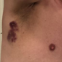 Hematoma under my arm from a deep tissue massage. Hematoma under my arm from a deep tissue massage.