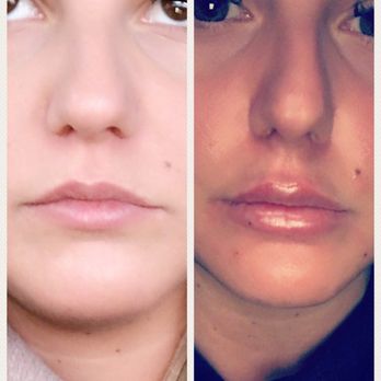 Skin Deep Laser Spa - Lips by Nina! Photo taken directly after injections, so still swollen. But she did a wonderful job. Would definitely recommend - Laser Hair Removal Near Me - Strongsville, Ohio Skin Deep Laser Spa - Lips by Nina! Photo taken directly after injections, so still swollen. But she did a wonderful job. Would definitely recommend - Laser Hair Removal Near Me - Strongsville, Ohio