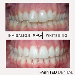 Minted Dental - Another lovely invisalign case with a happy patient!