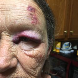 Comprehensive Spine & Pain - This was the morning my mom fell almost a year ago.